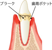 歯肉炎 説明図