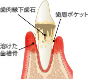 歯周炎 説明図