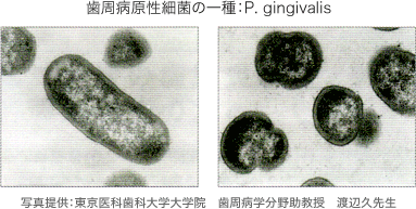 歯周病原性細菌の一種：P. gingivalis　写真提供：東京医科歯科大学大学院　歯周病学分野助教授　渡辺久先生