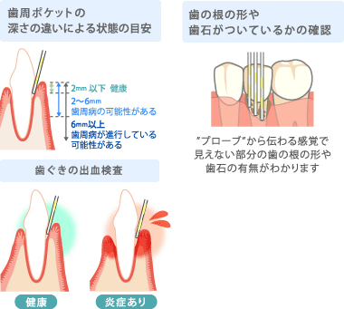 歯周ポケットの深さの違いによる状態の目安・・・2mm以下／健康、2～6mm以下／歯周病の可能性がある、6mm以上／歯周病が進行している可能性がある　歯ぐきの出血検査・・・健康／出血がない、炎症あり／出血がある　歯の根の形や歯石がついているかの確認・・・「プロープ」から伝わる感覚で見えない部分の歯の根の形や歯石の有無がわかります。