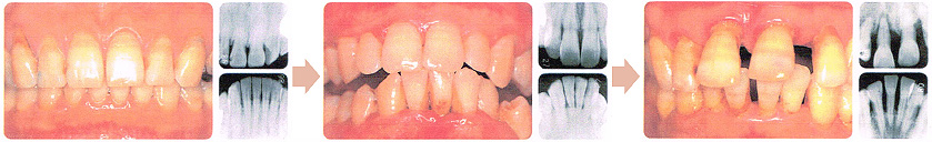歯周疾患の進行（１）