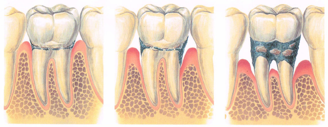 歯周疾患の進行（２）