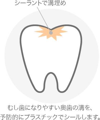シーラントで溝埋め むし歯になりやすい奥歯の溝を、予防的にプラスチックでシールします。